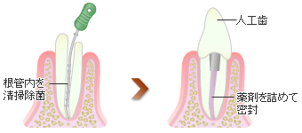 根管治療